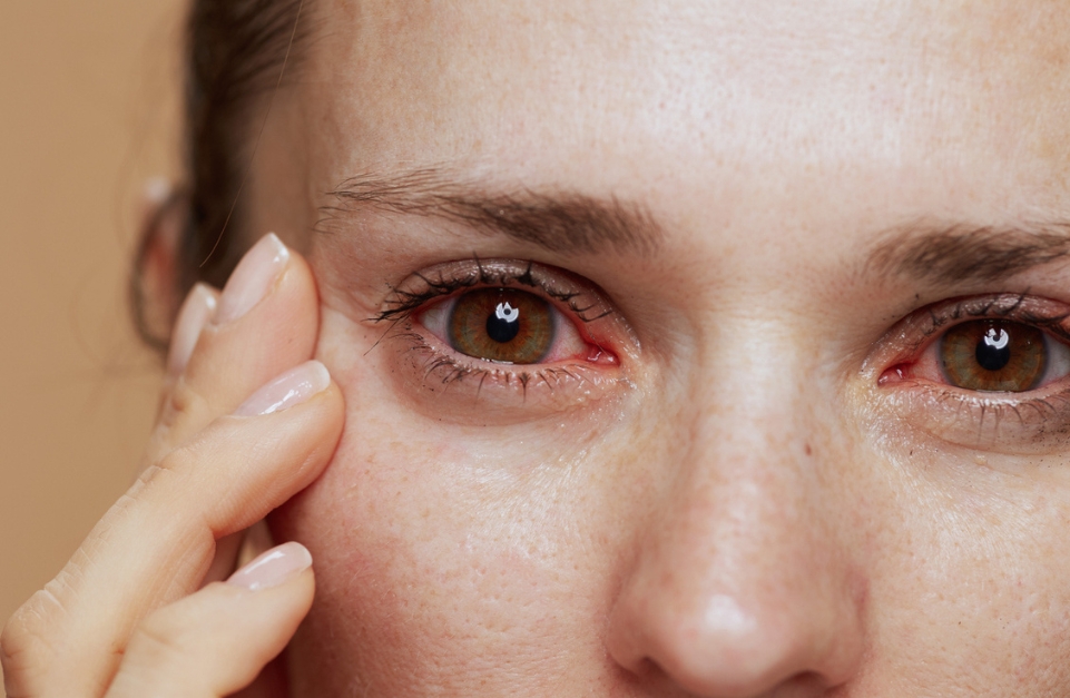 Dry Eye Syndrome Causes